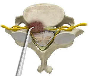 Disc Replacement/Fusion