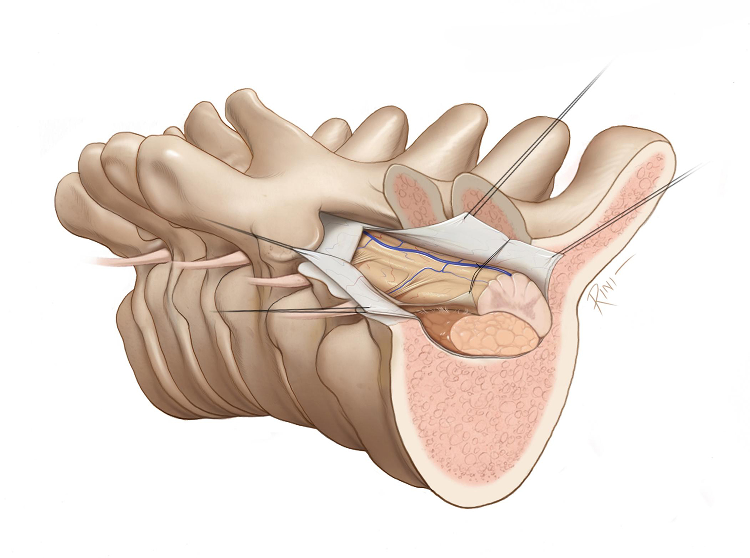 Disc Replacement/Fusion