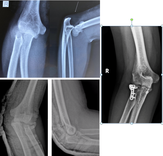 Fracture Dislocation Of Elbow Treatment In Coimbatore 